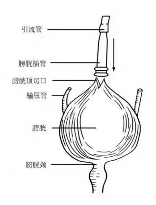 膀胱腹膜反折距膀胱有几厘米