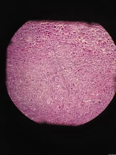 转移性低分化腺癌讨论病例【胸部等器官疾病诊断论坛病例160】