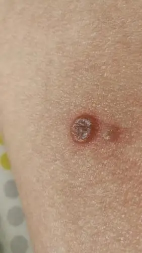 大腿内侧长了个痘痘,这是啥?怎么治?