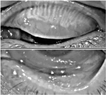 睑板腺萎缩近1/2,残余睑板腺形态弯曲