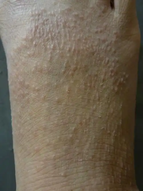 脚背上长满了像痱子一样的痘痘是怎么回事