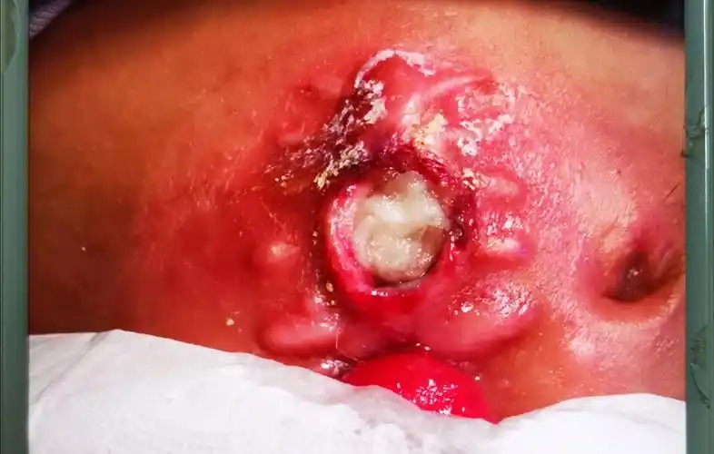 克罗恩病,是炎症性肠病的一种,属于免疫性疾病,和另外一种疾病溃疡性