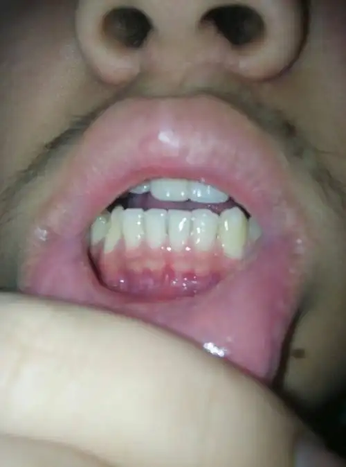 慎入,我这算牙龈萎缩吗?有没牙医或懂行的在线.