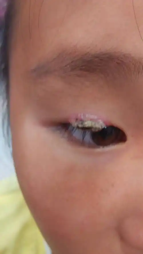 10岁小女孩眼睛上长了个东西,希望有了解的帮忙看看