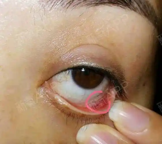 外割眼袋一年了但是眼下方有个豆子大的疙瘩怎么办