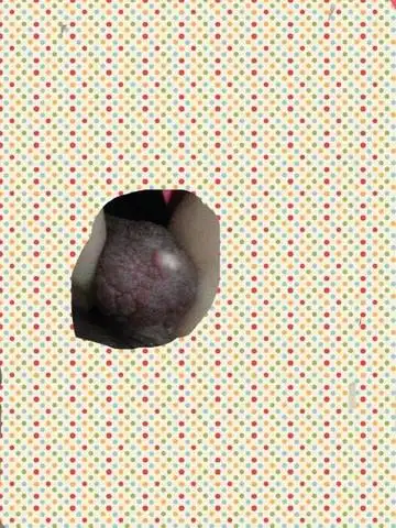 宝妈e乳头堵塞,有个小白点,这种原因主要是由于孩子长时间不吮吸引起