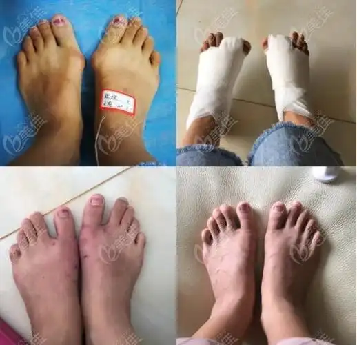 北京做大脚骨的专科医院汇总哪家矫正大脚骨医院正规一看就清楚
