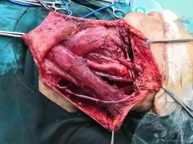 五区颈部淋巴清扫处女作