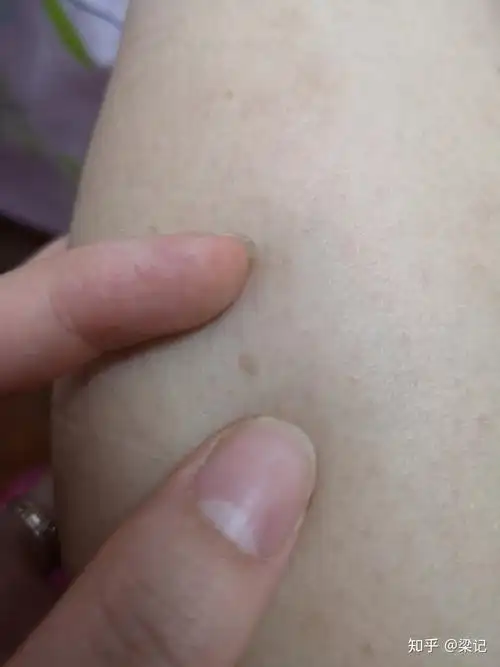 注射了九价hpv疫苗后,长了丝状疣和扁平疣,怎么办?