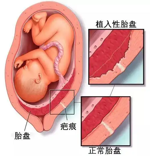 根据胎盘附着或侵入子宫程度分为以下的三种:粘连性胎盘:绒毛膜绒毛已