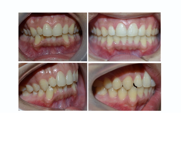 牙齿不齐,除了影响美观,还有什么危害?