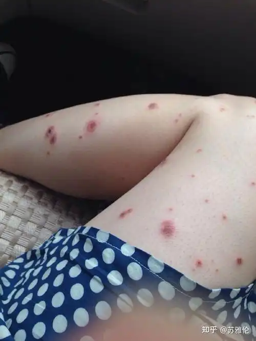 也不敢自己瞎捣鼓了,去我们这的诊所看,说我是湿气重,长的湿疹,给拿了