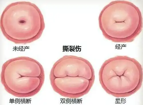 无论顺产还是剖腹产,产妇身上这几处会自动修复,没必要花冤枉钱