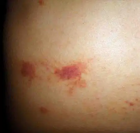 请大家看附件.可不可以告诉是什麼虫咬的呀?