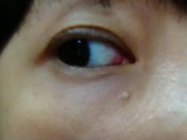 请教有人知道眼睛下方这个白色的小包是什么?