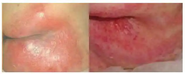 失禁性皮炎莫要误认为是压力性损伤