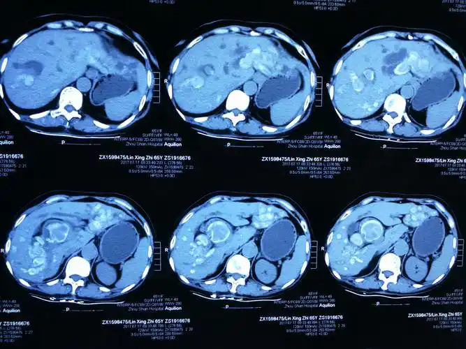 罕见巨大胆管结石一例经验分享