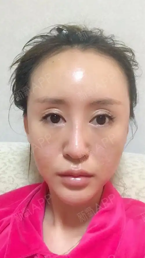 脂肪填充第三天输液三天头袍替肖座脸还是肿不过脸不疼_圈子-新氧美容