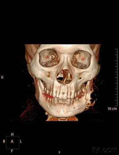 下颌骨病例有病理病理结果造釉细胞瘤