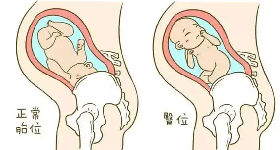 臀位是什么原因造成的?胎儿出现臀位的几率有多大