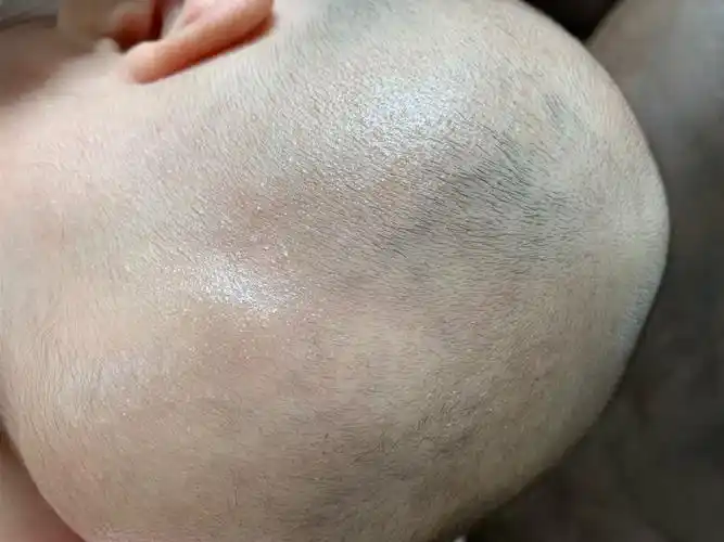 我女儿目前头和脸上有干性湿疹已每天用白凡士林保湿空调温度