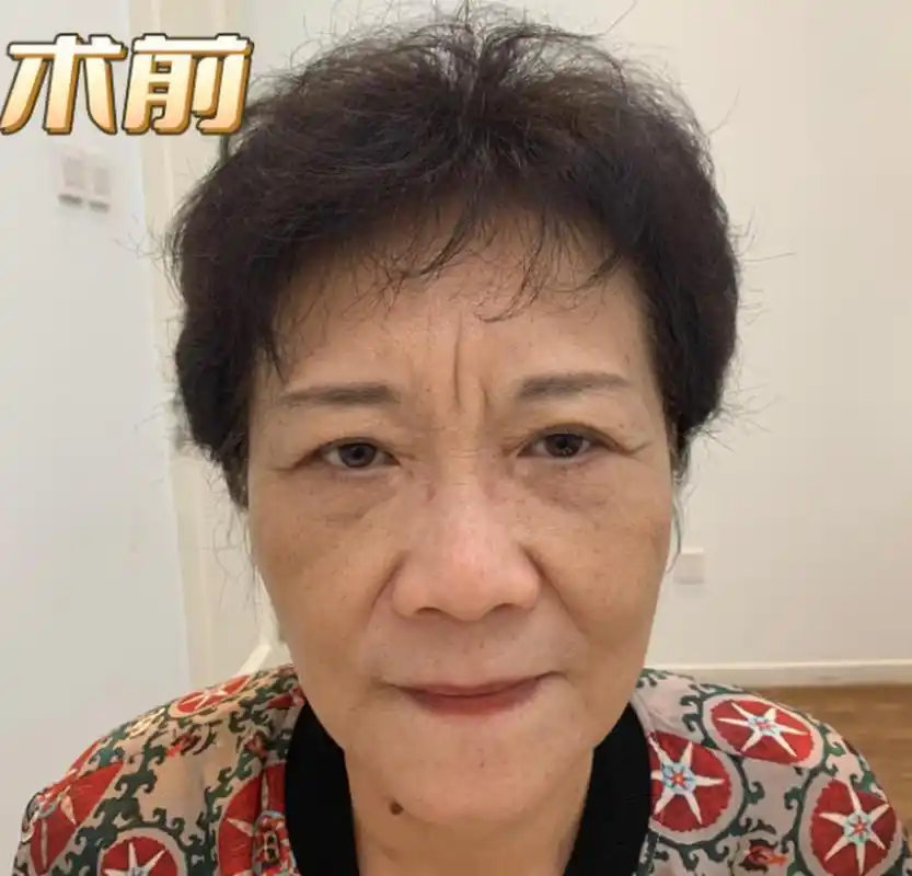 真的会让一个人显得很凶,比如下图的大姐,额头上那么严重的川字纹,让