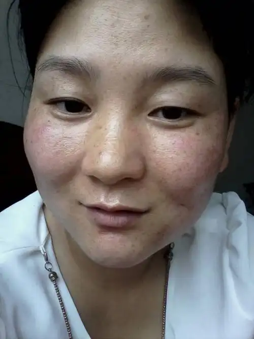 斑能祛吗?是晒斑