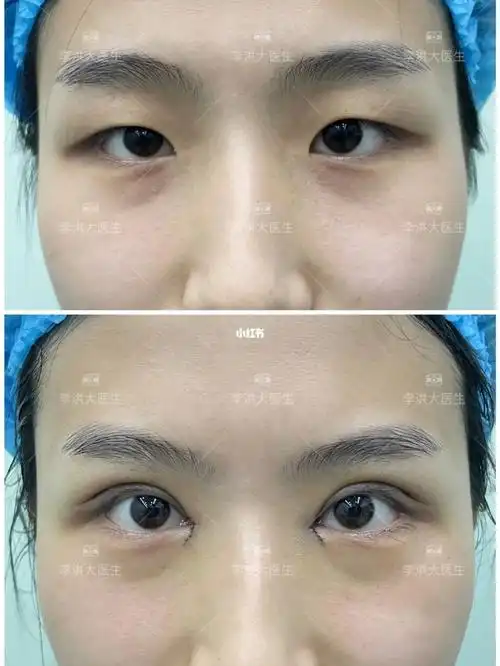 上睑下垂大小眼_大小眼_暑假_睫毛_内眼角_双眼皮_美妆_医美整形