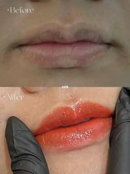原本的唇色唇型真的一言难尽皮脂腺异位导致唇部色差严重变形唇色也