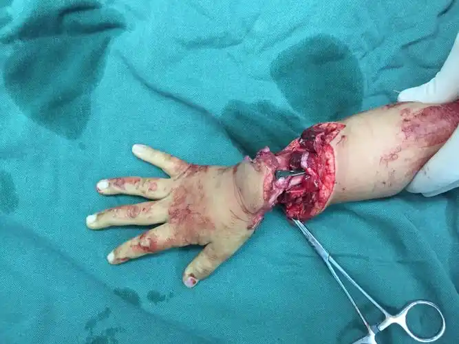 小孩断肢离断再植