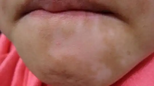 小孩身上有白斑图片