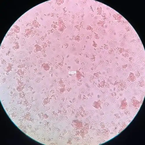 交叉配血40倍镜凝集现象