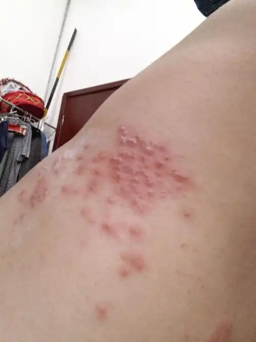 急急急,腋下一段距离长了好多的红点点,刚开始有点痒,后来不痒了就是