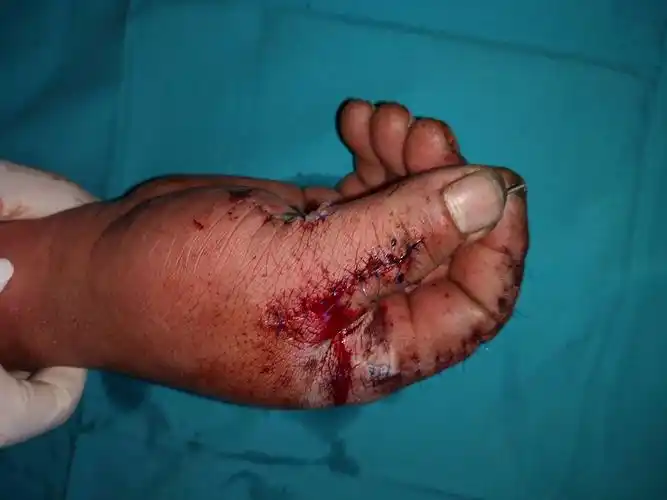 拇指挤压离断伤~血管移植多段,历经6小时,血管终于通血