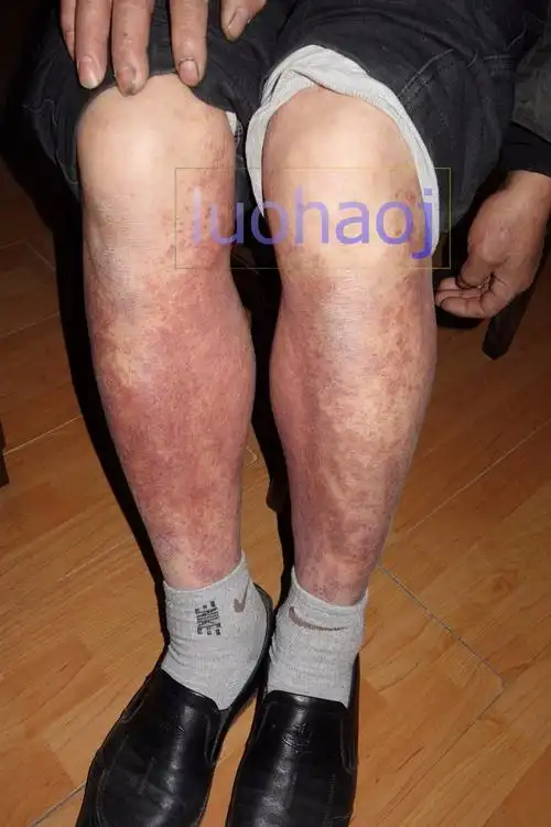 严重的双下肢小腿对称性色素紫癜样皮炎中西结合治疗医案