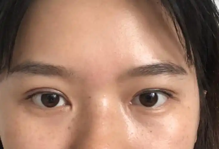 双眼皮术后68天大小眼内双是失败了吗