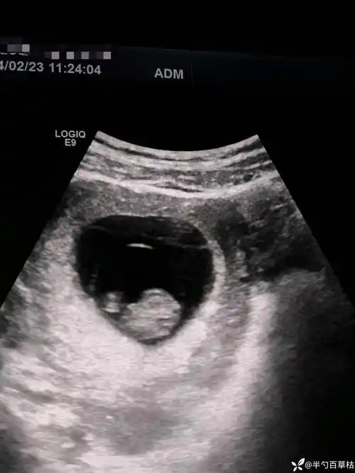 桃心78形状的孕囊关于绒毛膜囊羊膜囊卵黄囊