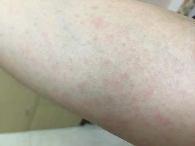 一外出身上就起大片红疹都来看看