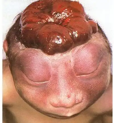 无脑儿 (8)_有来医生