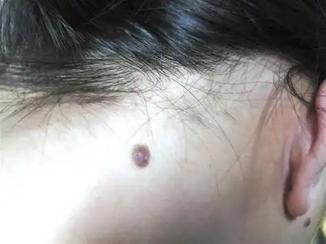 颈部左侧有颗痣代表什么 女孩脖子福气痣图片