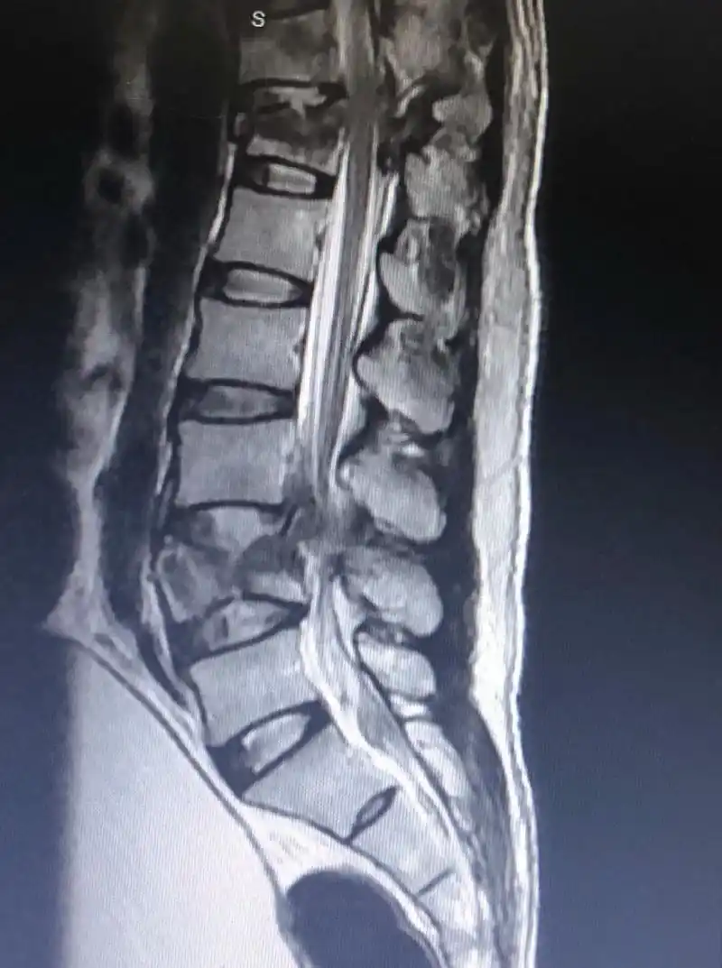 t12,l4椎体压缩性骨折伴截瘫……… - 抖音