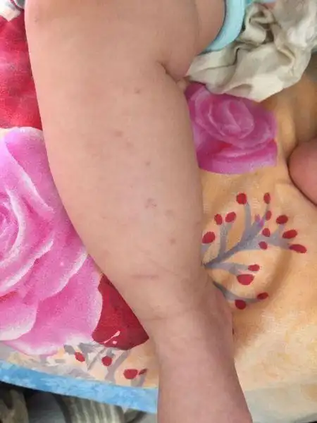 宝宝腿上起紫点.6个月大