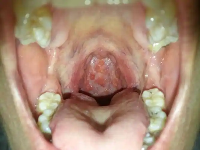 发炎吗喉咙?那喉壁小红肉是什么