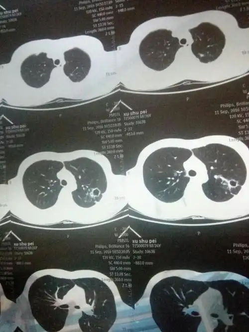做了一个加强ct 报告如下: 左肺上叶条索状,斑片状高密度影,内见空洞
