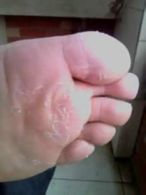 男性脚掌皮肤念珠菌病图片_有来医生