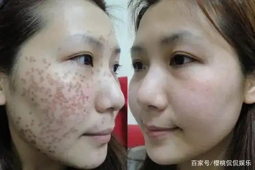 "老年斑"的克星,睡觉前偷偷涂一层,5次后斑连根拔起