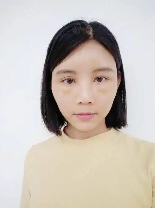 自体脂肪面部填充术后5天_面部填充术后5天_自体脂肪术后5天_面部轮廓