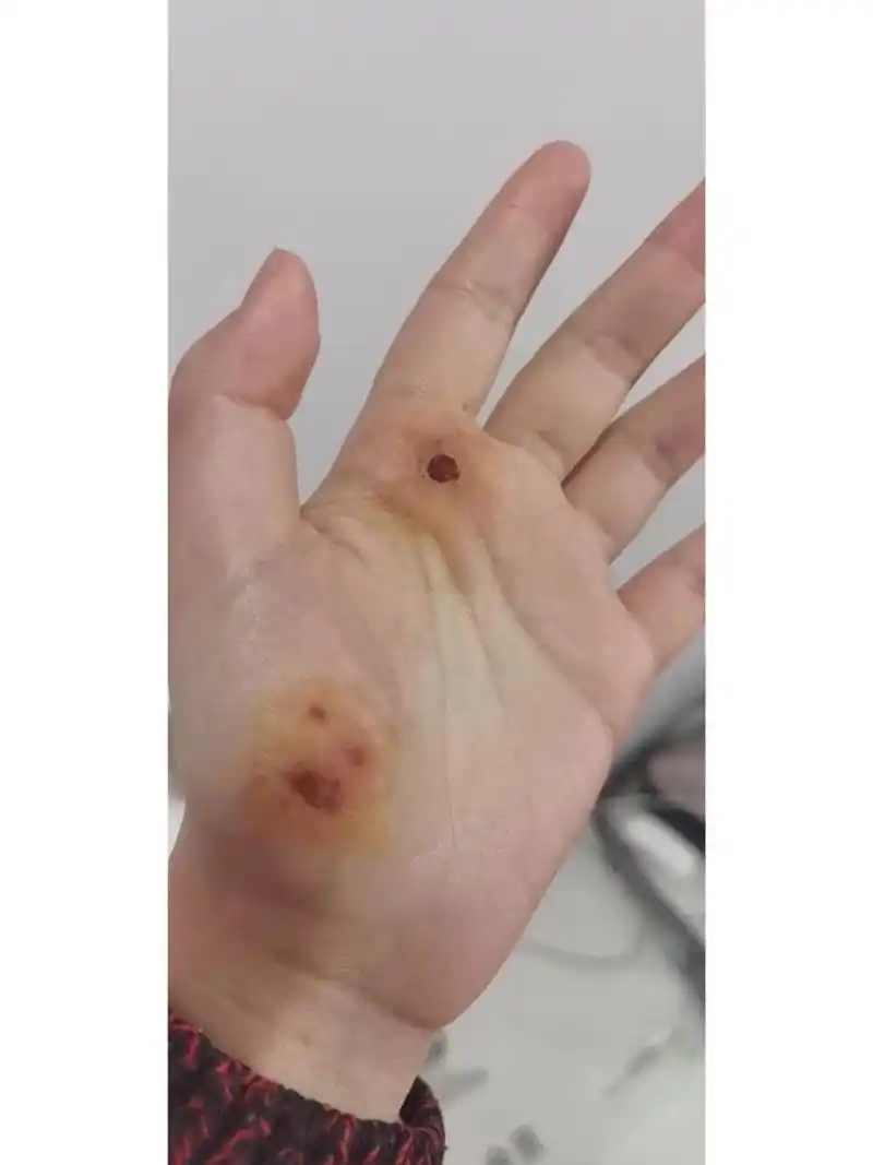 骑电动车手掌擦伤 怎么也没想到二十岁的人了能骑小黄电动车摔着梦回