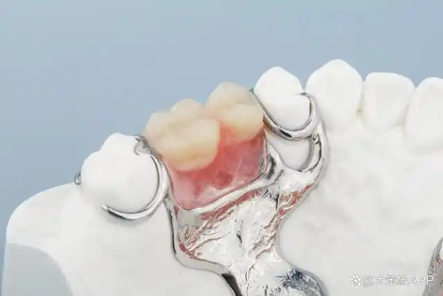 通常,拔牙后需要2～3个月待拔牙创口恢复后才可以镶牙.