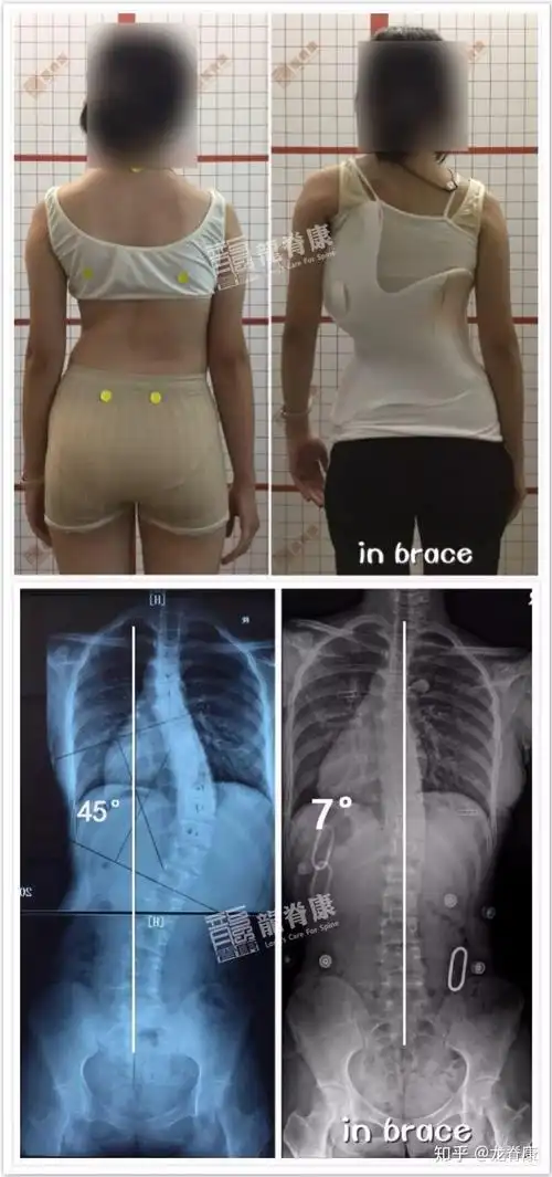 青少年脊柱侧弯患者脱支具的条件有哪些